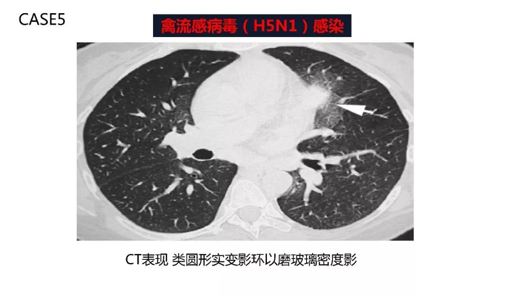 【PPT】以史为鉴，以影为鉴--COVID-19CT诊断、鉴别诊断与思考