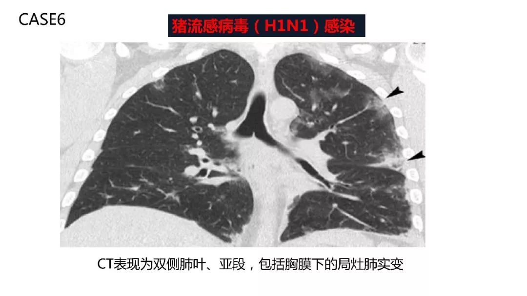 【PPT】以史为鉴，以影为鉴--COVID-19CT诊断、鉴别诊断与思考