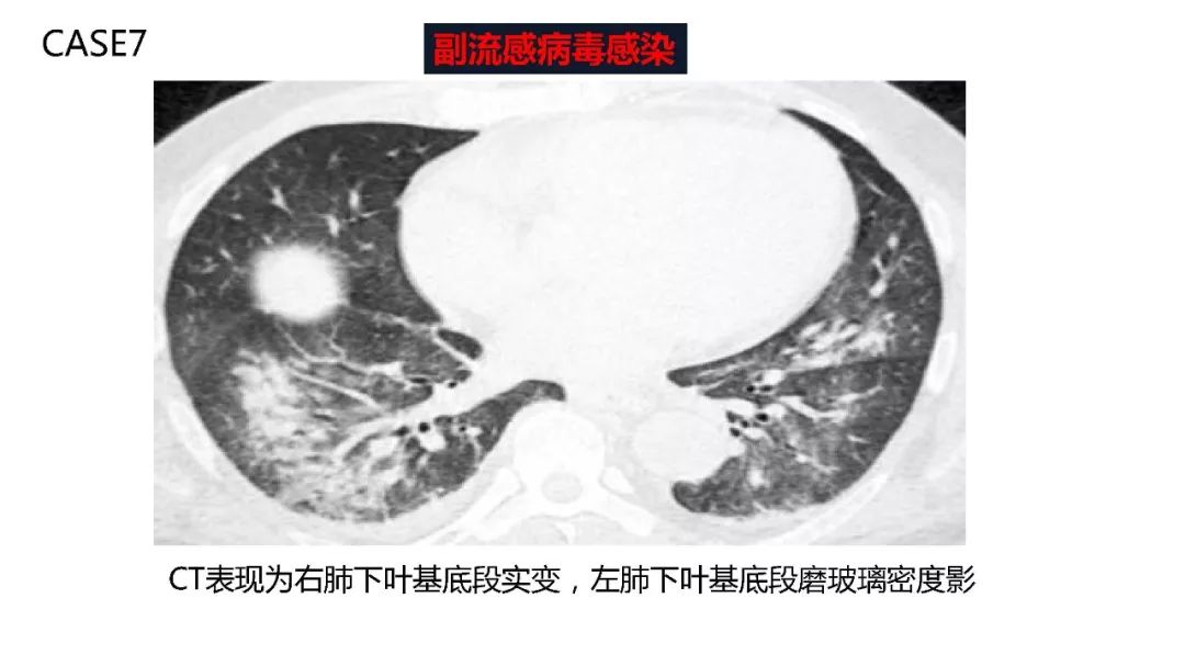 【PPT】以史为鉴，以影为鉴--COVID-19CT诊断、鉴别诊断与思考