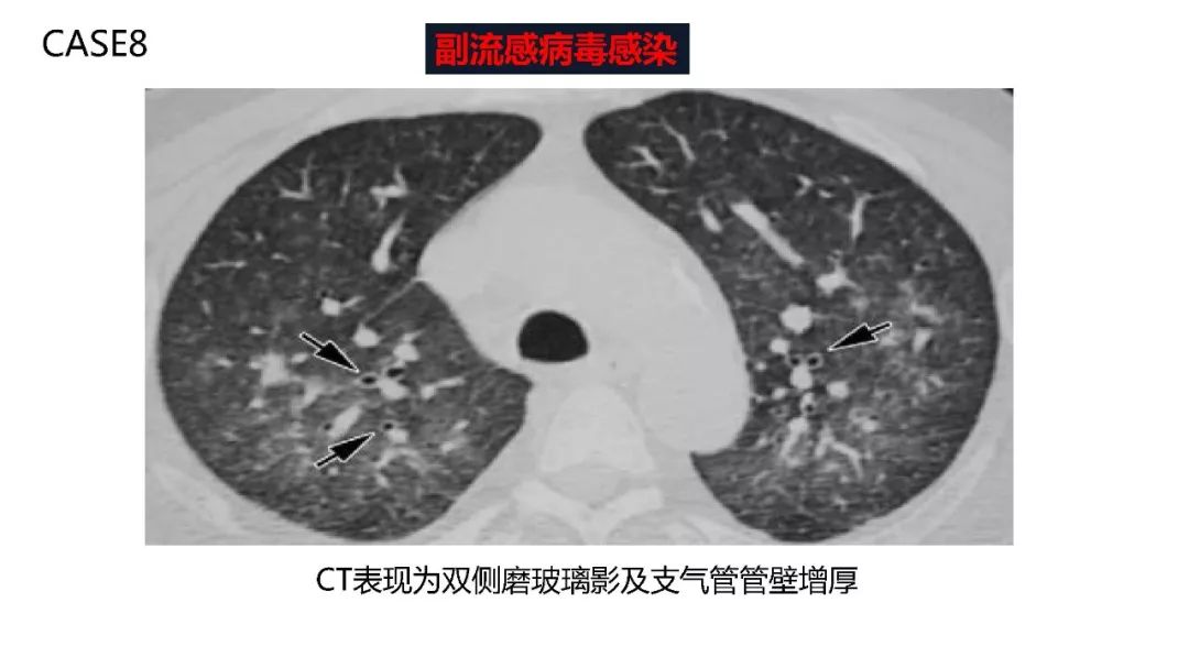 【PPT】以史为鉴，以影为鉴--COVID-19CT诊断、鉴别诊断与思考