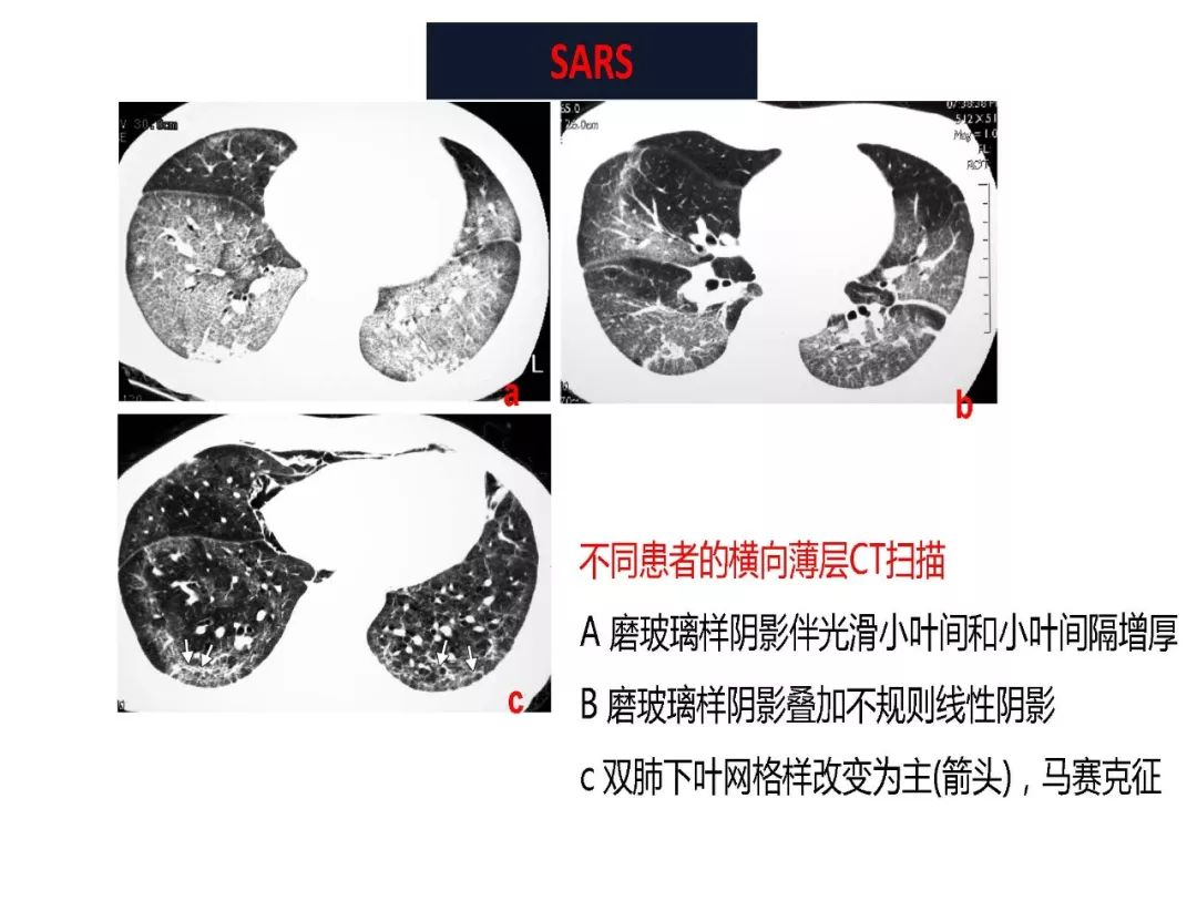【PPT】以史为鉴，以影为鉴--COVID-19CT诊断、鉴别诊断与思考