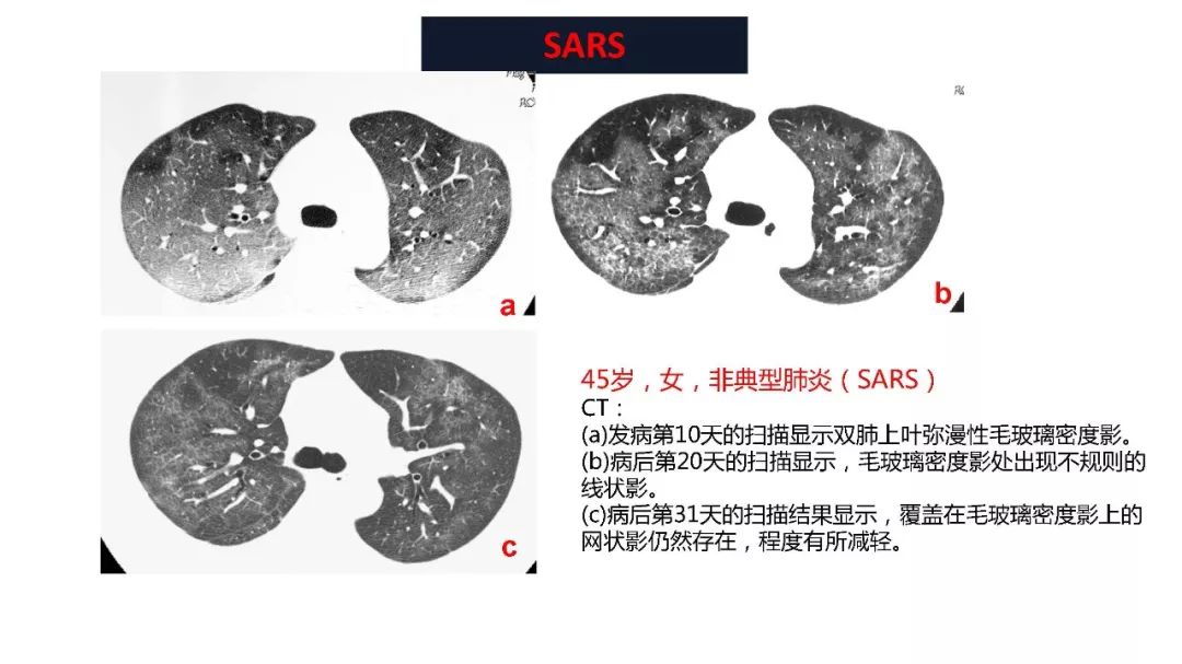 【PPT】以史为鉴，以影为鉴--COVID-19CT诊断、鉴别诊断与思考