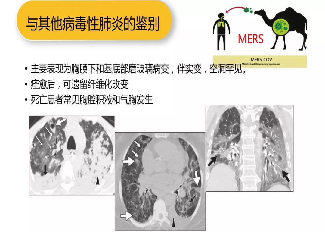 【PPT】以史为鉴，以影为鉴--COVID-19CT诊断、鉴别诊断与思考