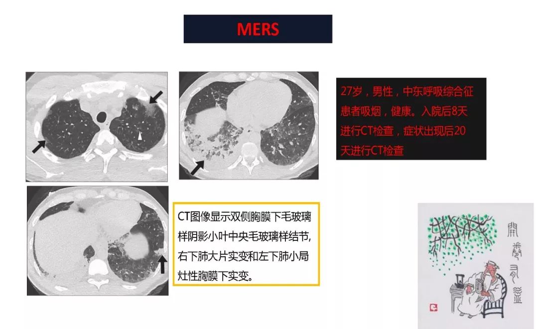 【PPT】以史为鉴，以影为鉴--COVID-19CT诊断、鉴别诊断与思考