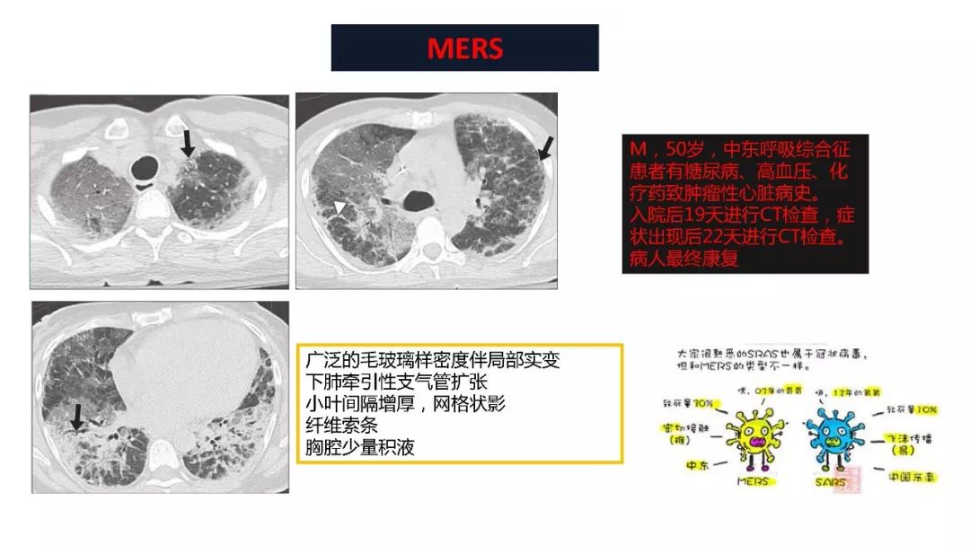 【PPT】以史为鉴，以影为鉴--COVID-19CT诊断、鉴别诊断与思考