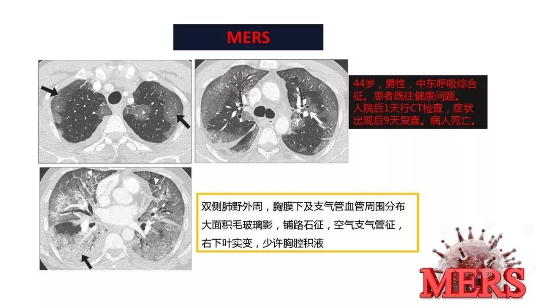 【PPT】以史为鉴，以影为鉴--COVID-19CT诊断、鉴别诊断与思考