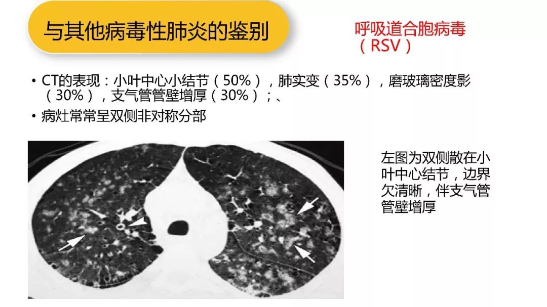 【PPT】以史为鉴，以影为鉴--COVID-19CT诊断、鉴别诊断与思考