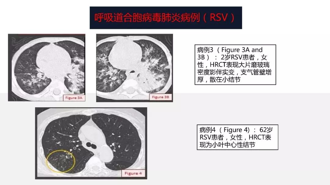 【PPT】以史为鉴，以影为鉴--COVID-19CT诊断、鉴别诊断与思考