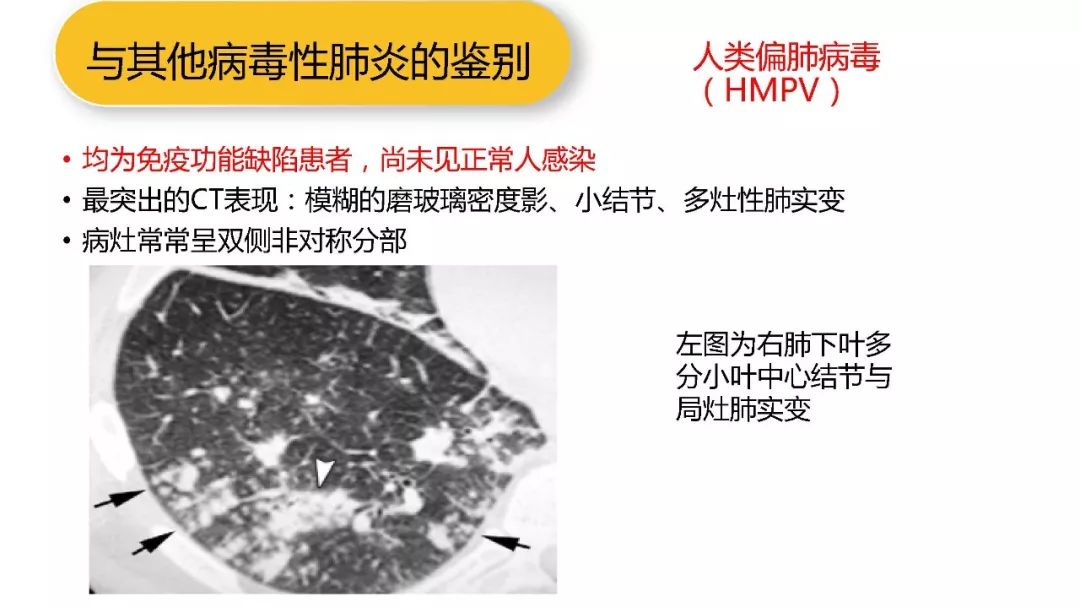 【PPT】以史为鉴，以影为鉴--COVID-19CT诊断、鉴别诊断与思考