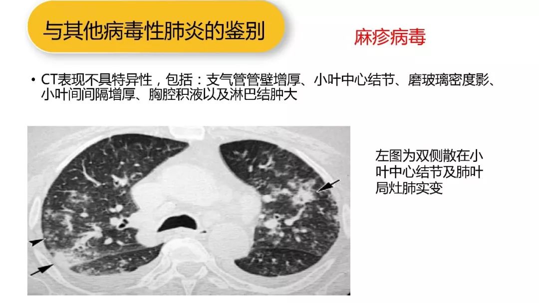【PPT】以史为鉴，以影为鉴--COVID-19CT诊断、鉴别诊断与思考