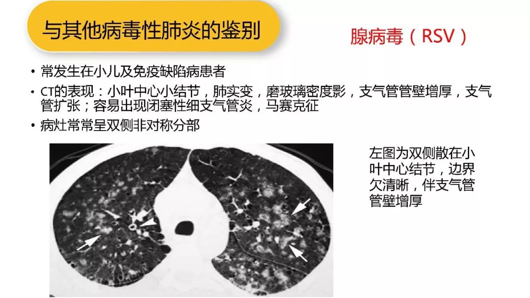 【PPT】以史为鉴，以影为鉴--COVID-19CT诊断、鉴别诊断与思考