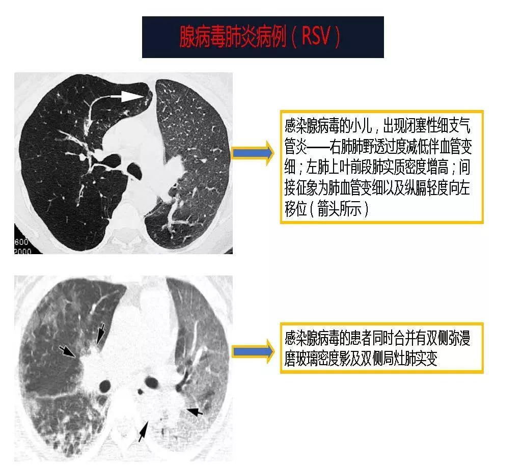 【PPT】以史为鉴，以影为鉴--COVID-19CT诊断、鉴别诊断与思考