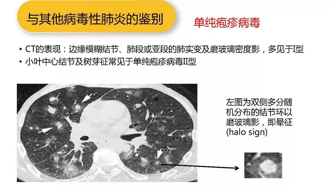 【PPT】以史为鉴，以影为鉴--COVID-19CT诊断、鉴别诊断与思考