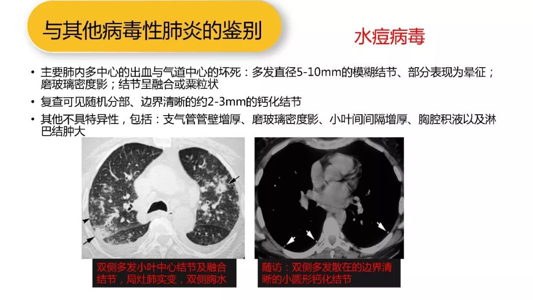 【PPT】以史为鉴，以影为鉴--COVID-19CT诊断、鉴别诊断与思考