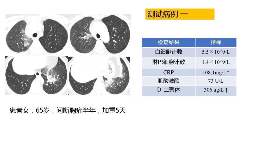 【PPT】以史为鉴，以影为鉴--COVID-19CT诊断、鉴别诊断与思考