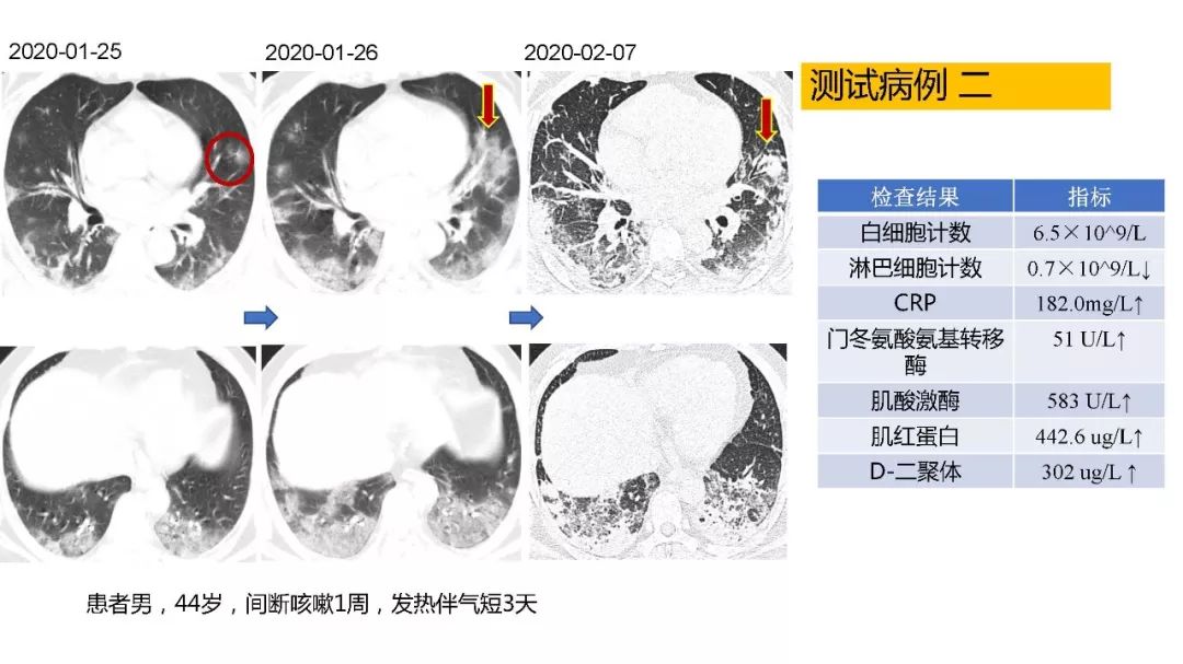 【PPT】以史为鉴，以影为鉴--COVID-19CT诊断、鉴别诊断与思考