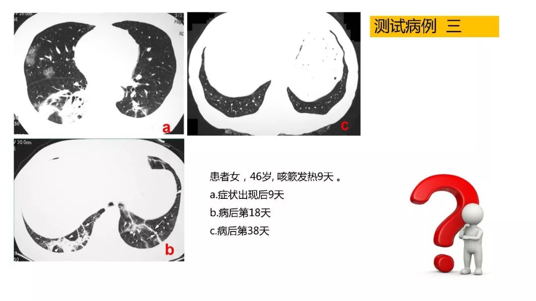 【PPT】以史为鉴，以影为鉴--COVID-19CT诊断、鉴别诊断与思考