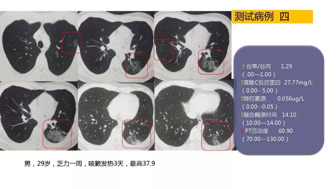 【PPT】以史为鉴，以影为鉴--COVID-19CT诊断、鉴别诊断与思考