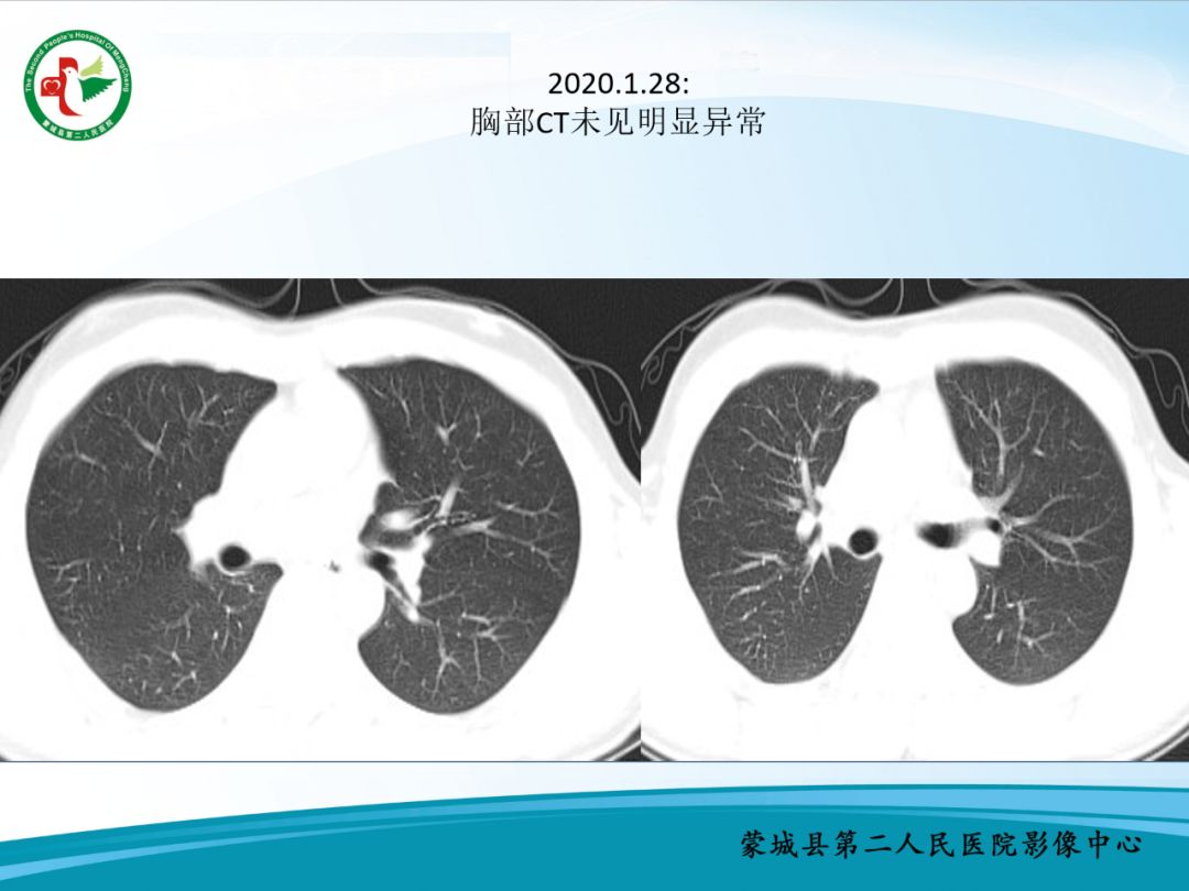 【PPT】十例新冠肺炎影像学汇报