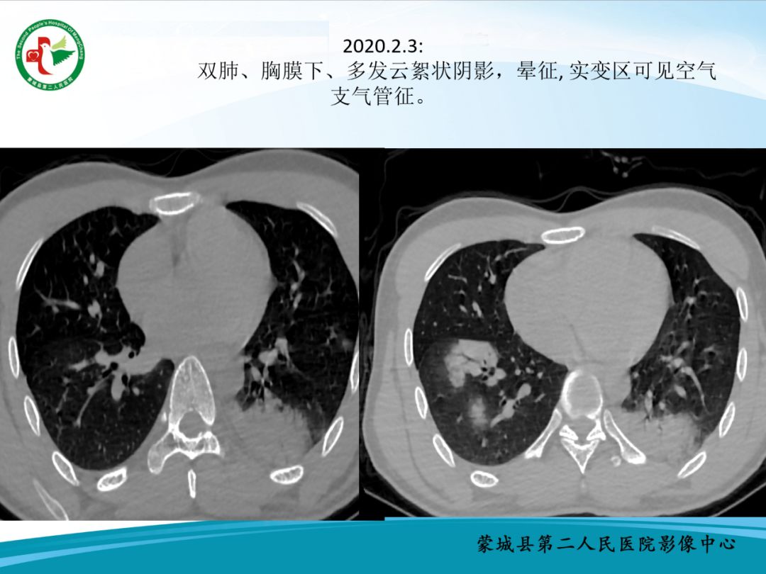 【PPT】十例新冠肺炎影像学汇报