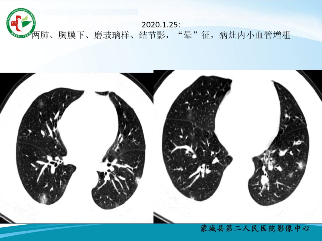 【PPT】十例新冠肺炎影像学汇报