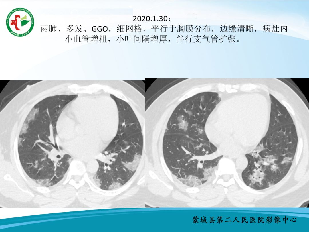 【PPT】十例新冠肺炎影像学汇报