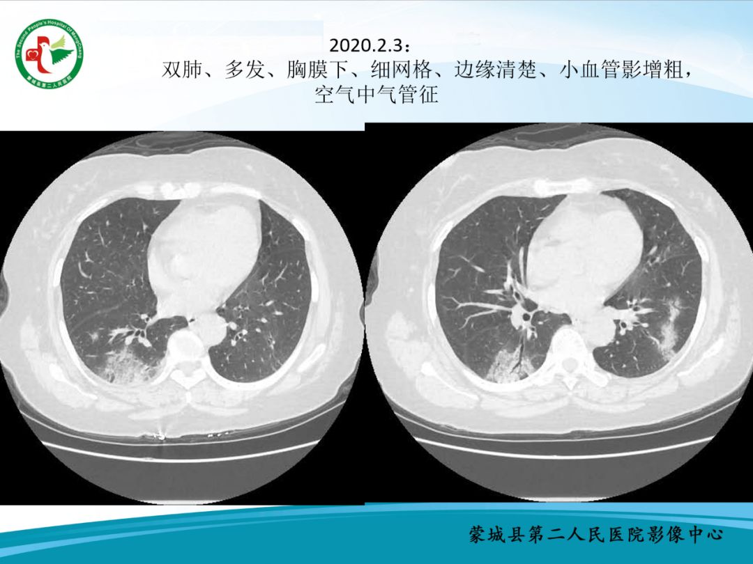 【PPT】十例新冠肺炎影像学汇报