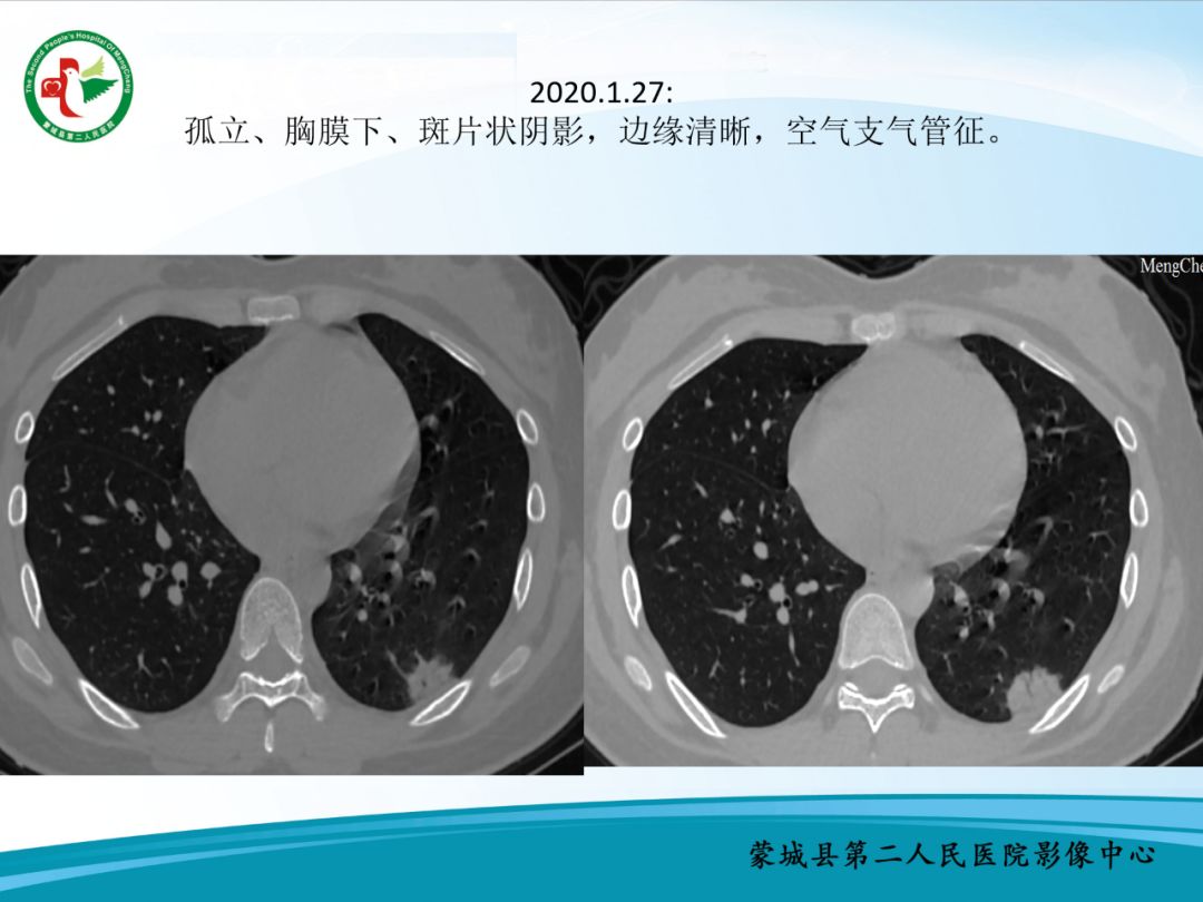 【PPT】十例新冠肺炎影像学汇报