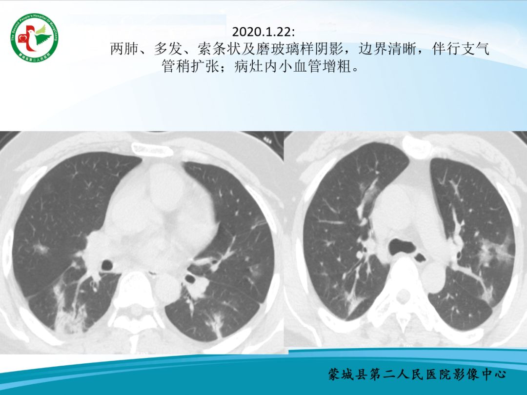 【PPT】十例新冠肺炎影像学汇报