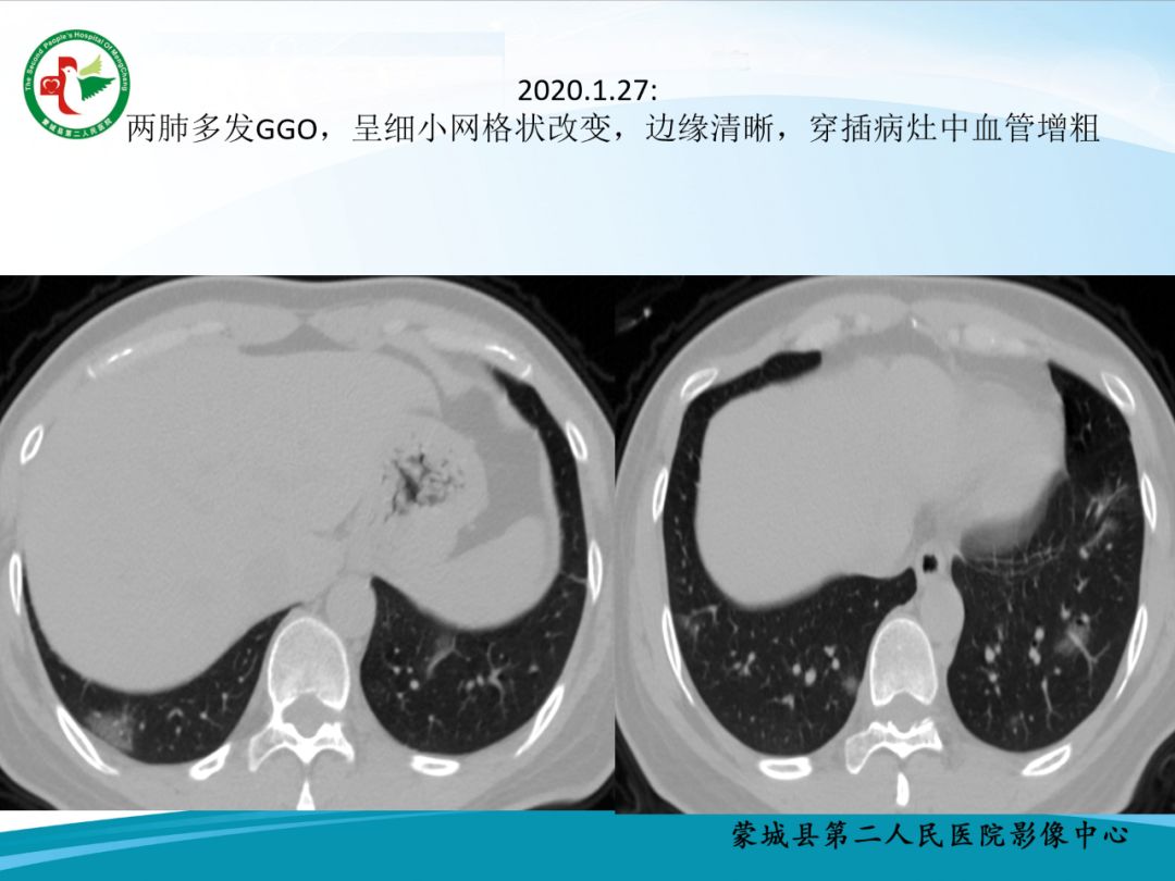【PPT】十例新冠肺炎影像学汇报