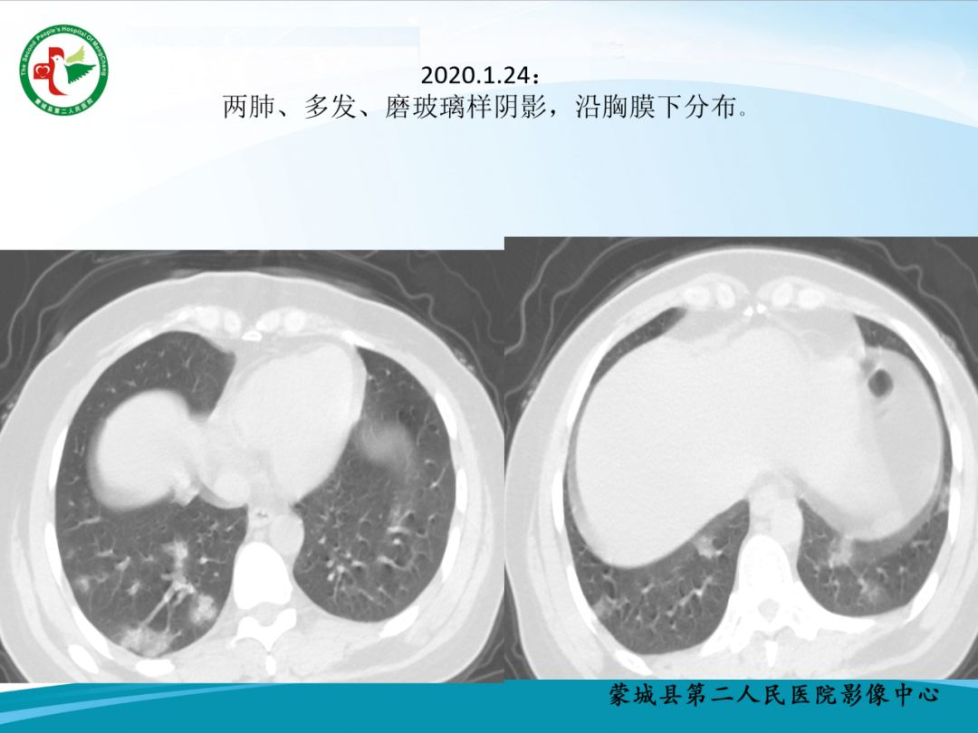【PPT】十例新冠肺炎影像学汇报