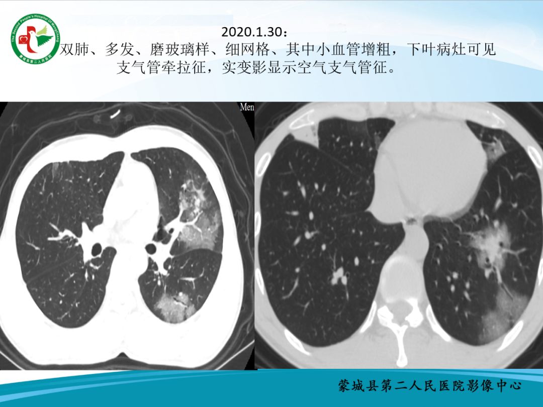 【PPT】十例新冠肺炎影像学汇报