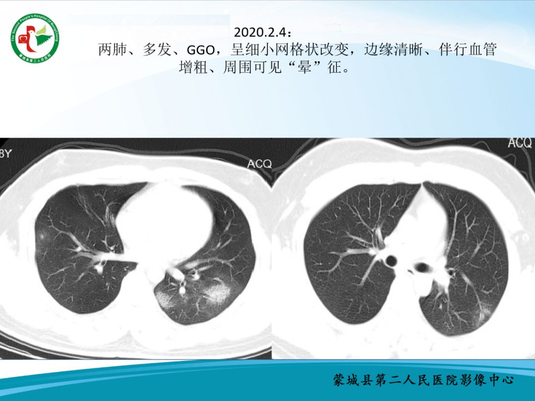 【PPT】十例新冠肺炎影像学汇报