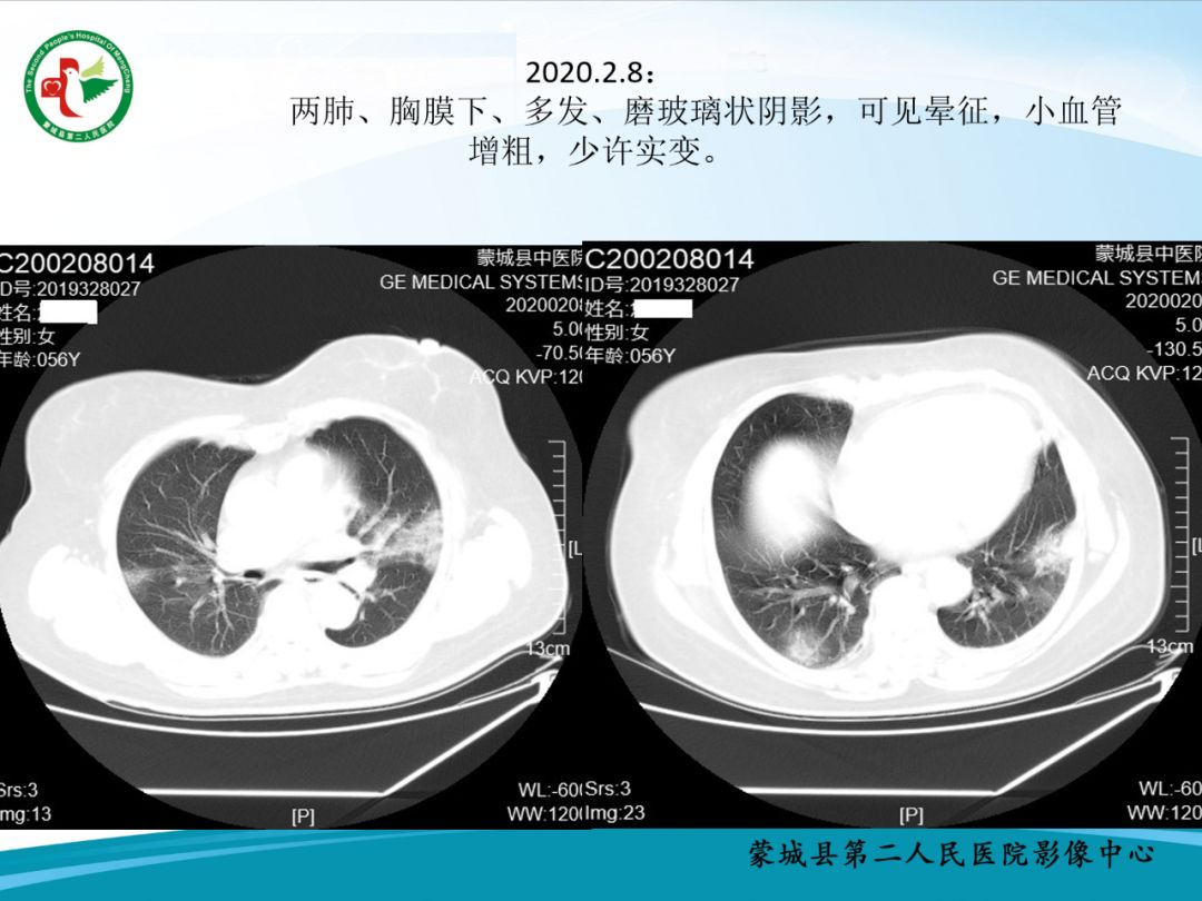 【PPT】十例新冠肺炎影像学汇报