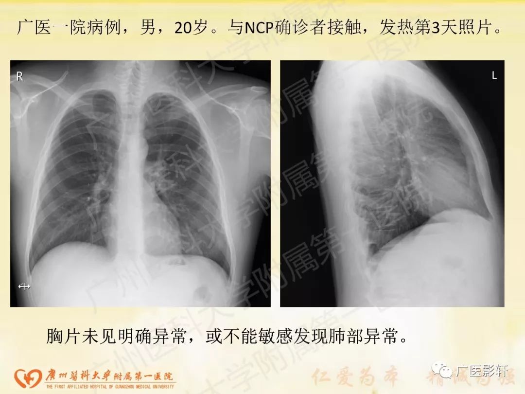 【PPT】新型冠状病毒肺炎影像学特点