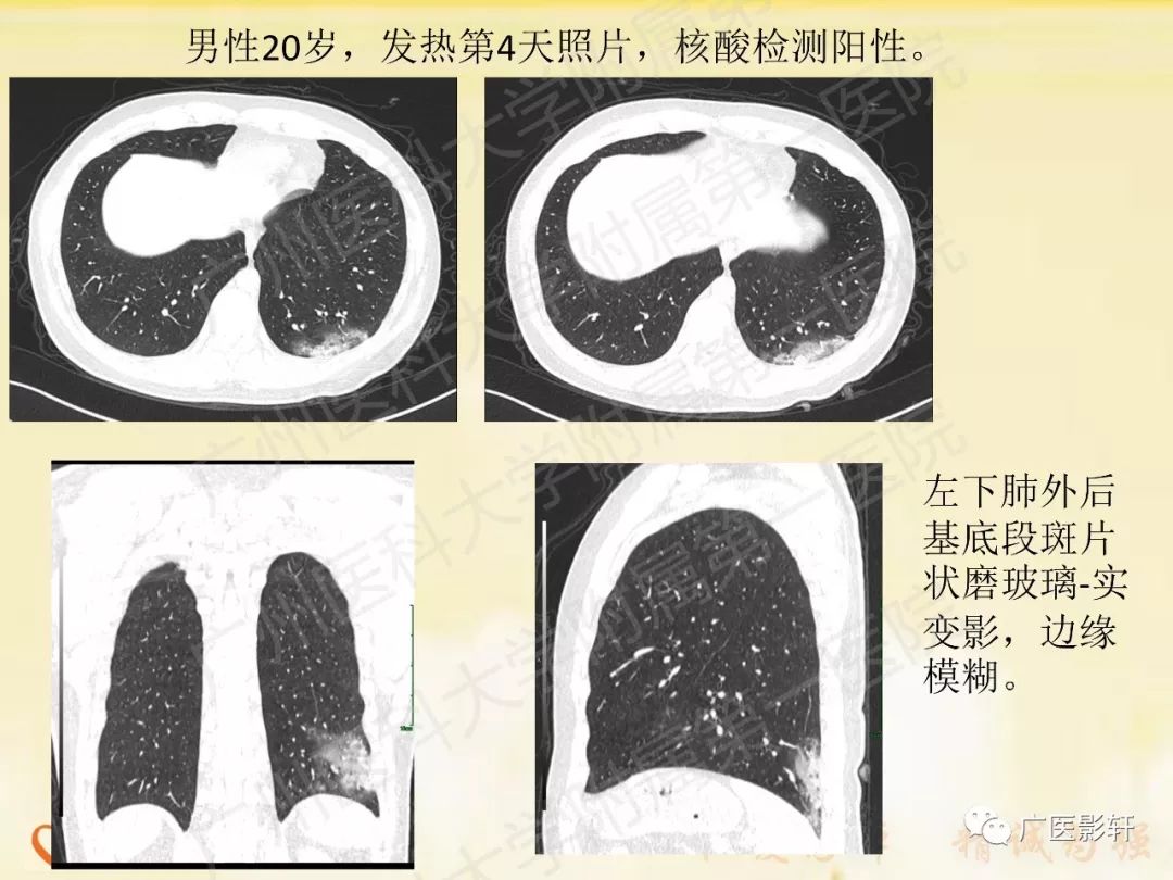 【PPT】新型冠状病毒肺炎影像学特点