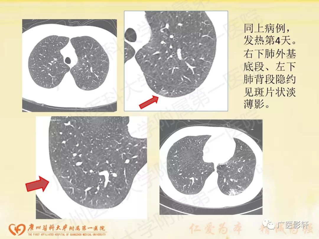 【PPT】新型冠状病毒肺炎影像学特点