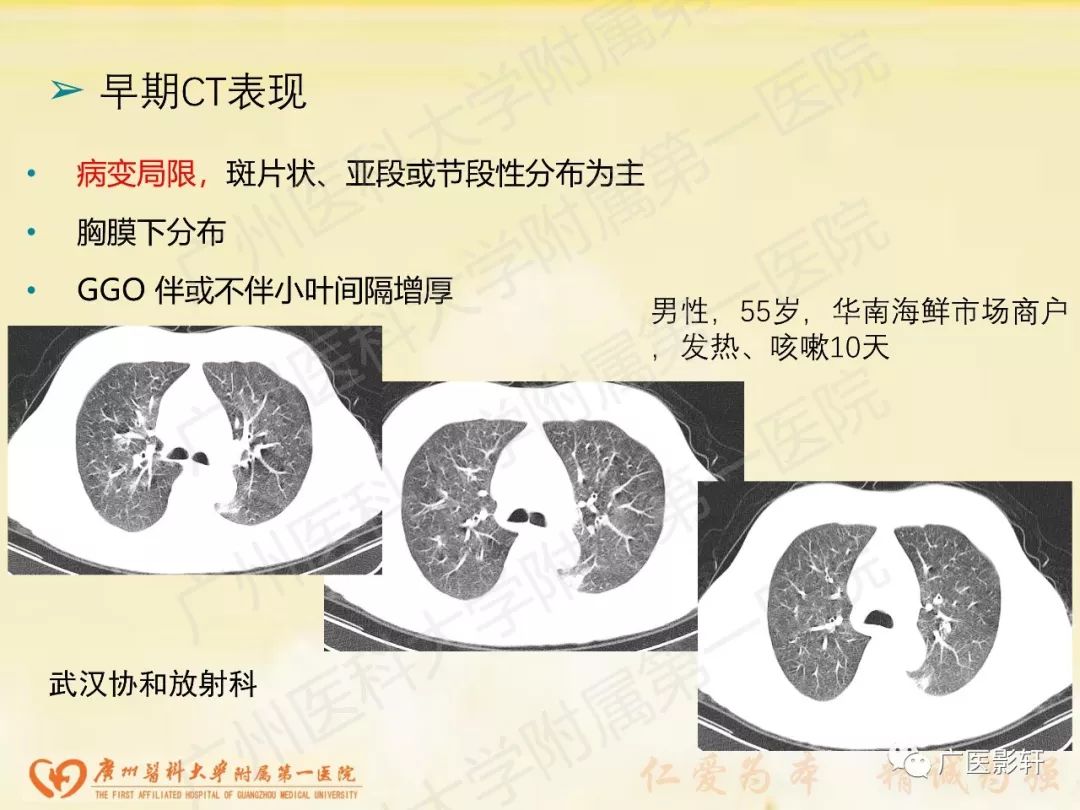 【PPT】新型冠状病毒肺炎影像学特点
