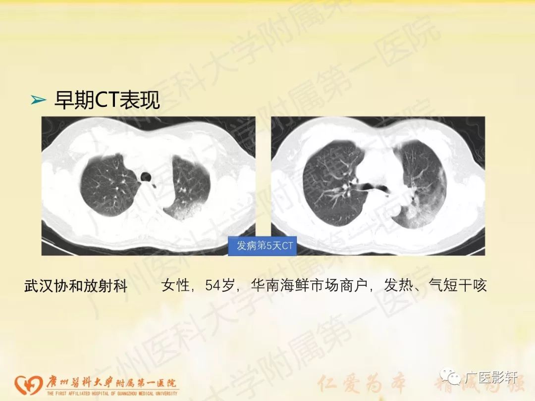 【PPT】新型冠状病毒肺炎影像学特点