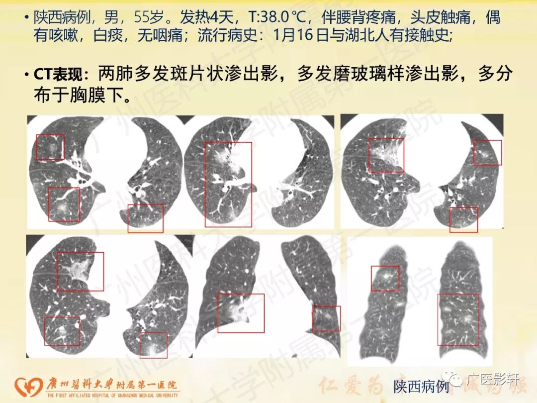 【PPT】新型冠状病毒肺炎影像学特点