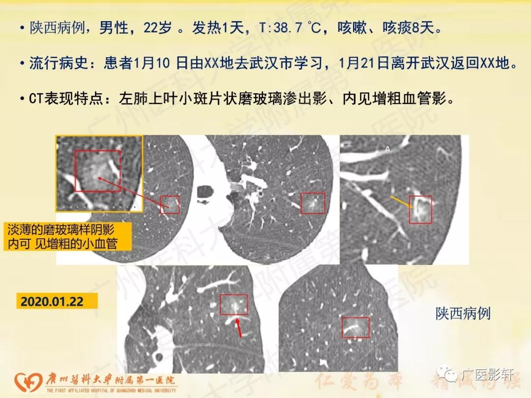 【PPT】新型冠状病毒肺炎影像学特点