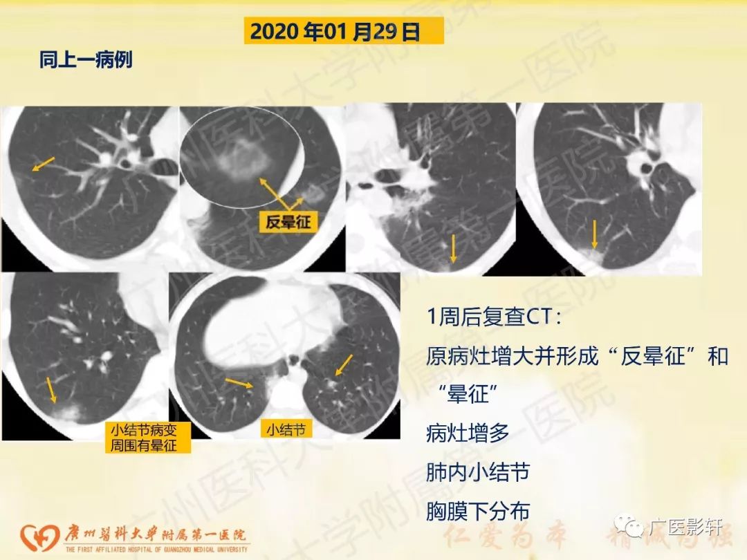 【PPT】新型冠状病毒肺炎影像学特点