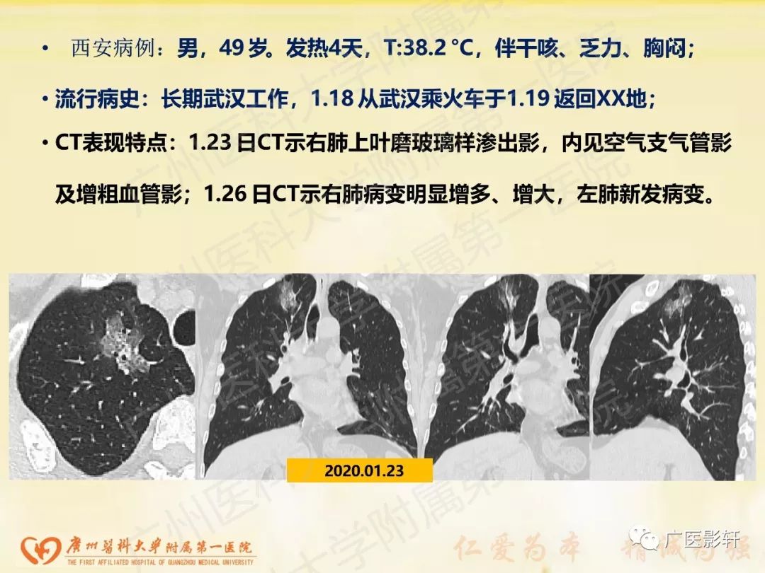 【PPT】新型冠状病毒肺炎影像学特点