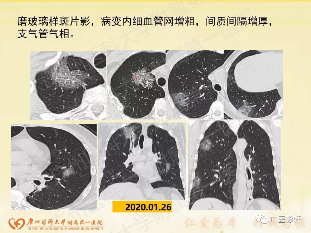 【PPT】新型冠状病毒肺炎影像学特点