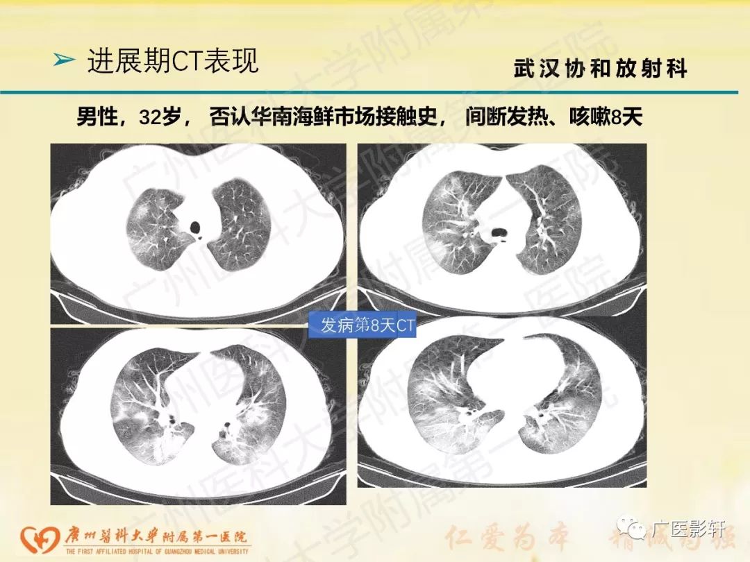 【PPT】新型冠状病毒肺炎影像学特点