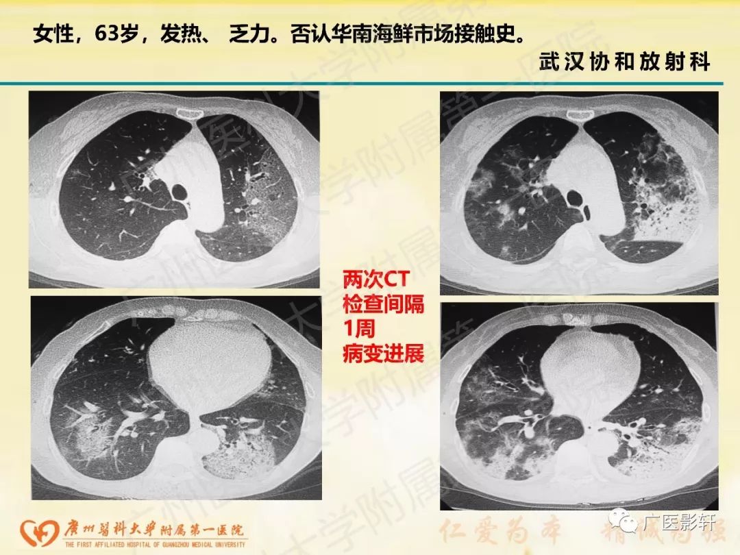 【PPT】新型冠状病毒肺炎影像学特点