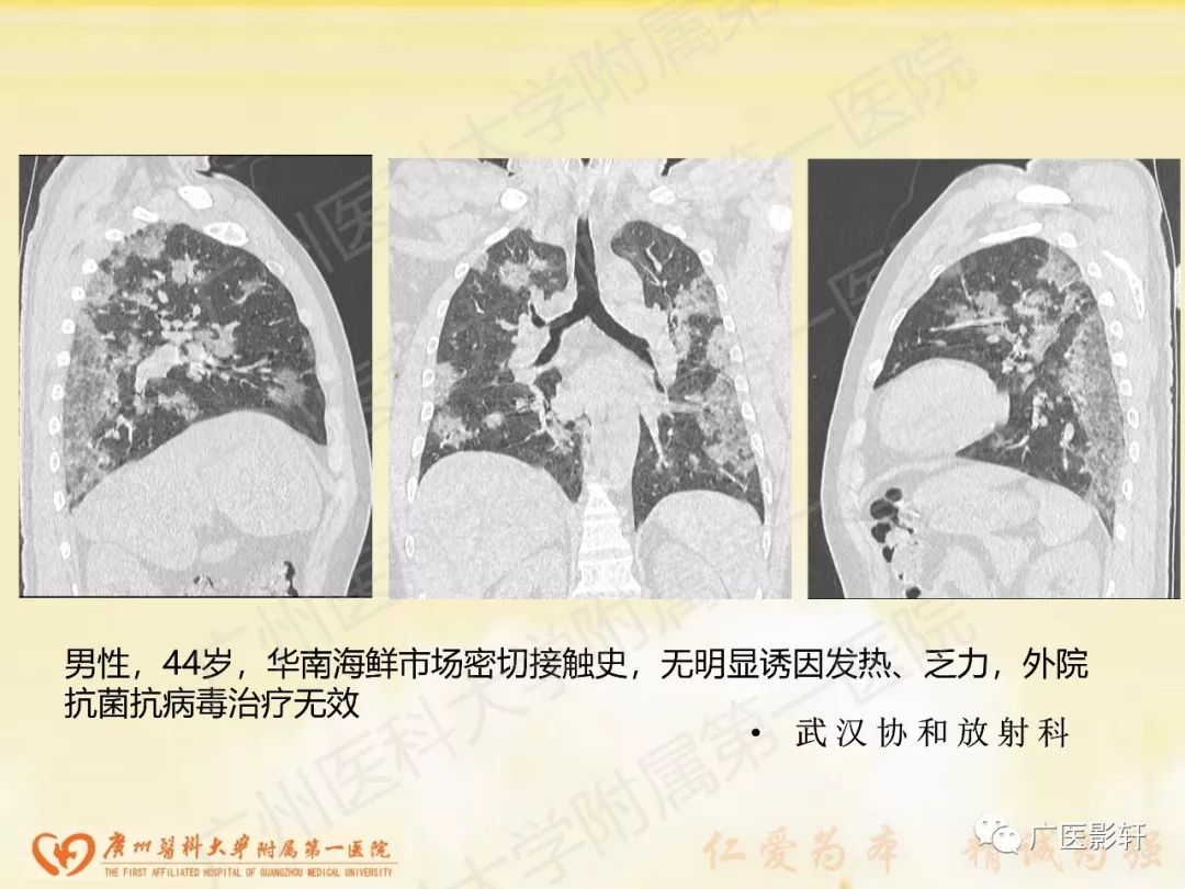 【PPT】新型冠状病毒肺炎影像学特点