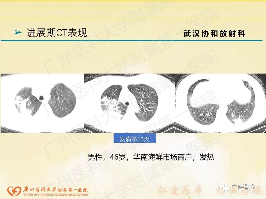【PPT】新型冠状病毒肺炎影像学特点