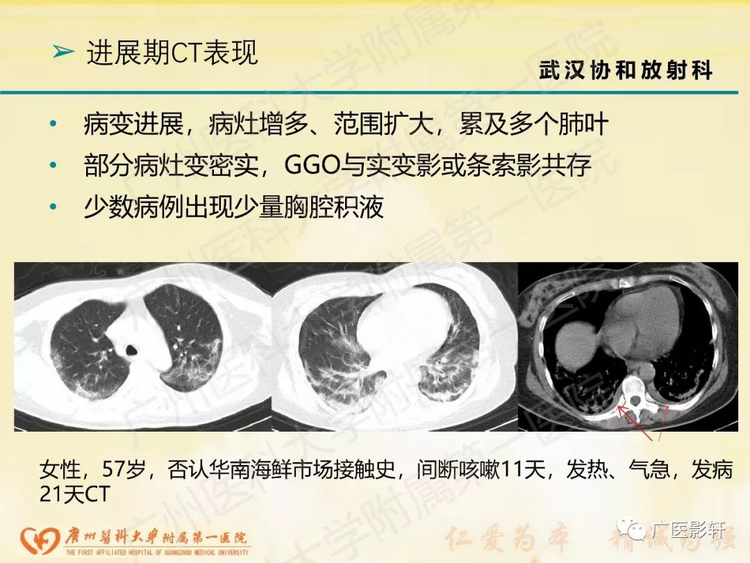 【PPT】新型冠状病毒肺炎影像学特点