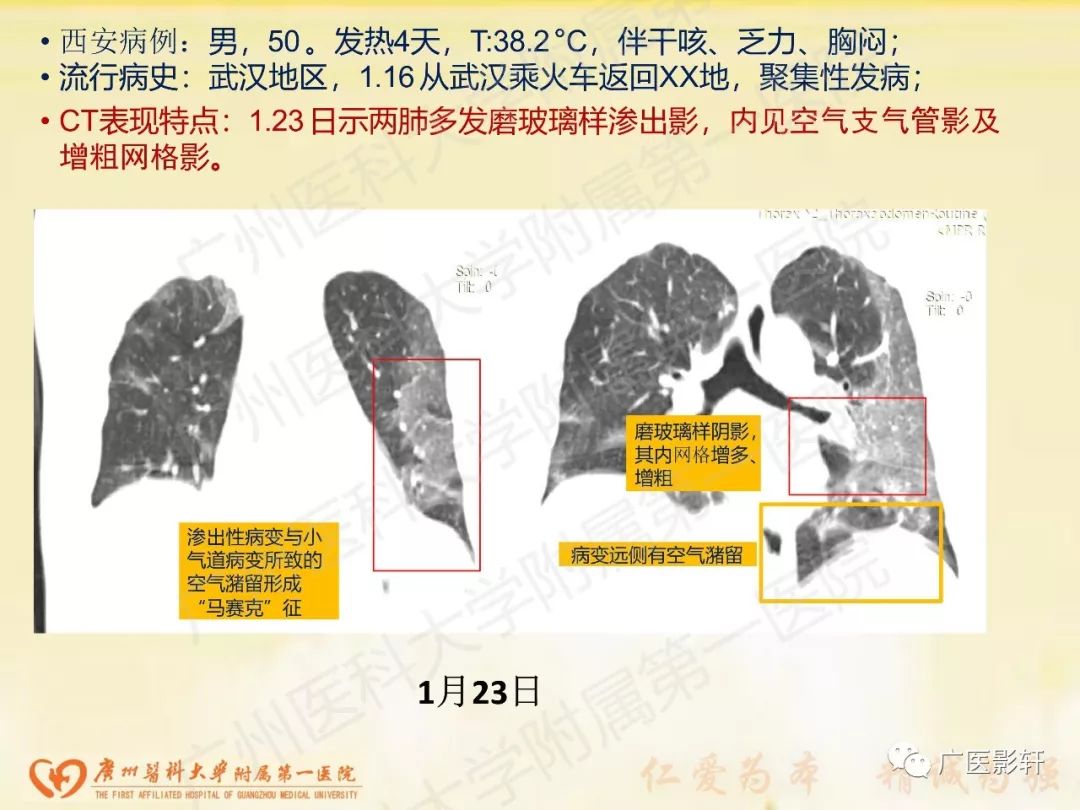 【PPT】新型冠状病毒肺炎影像学特点
